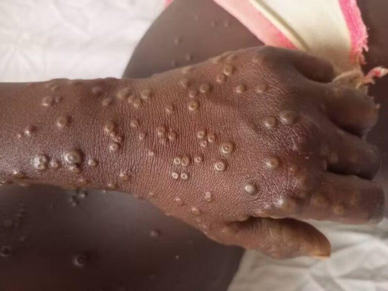 Sud-Kivu: 5 397 cas de MPOX déjà enregistrés et 4 841 guéris