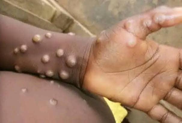 RDC: Plus de deux cent cas suspects de Mpox notifiés au Kongo Central (Division provinciale de la santé)