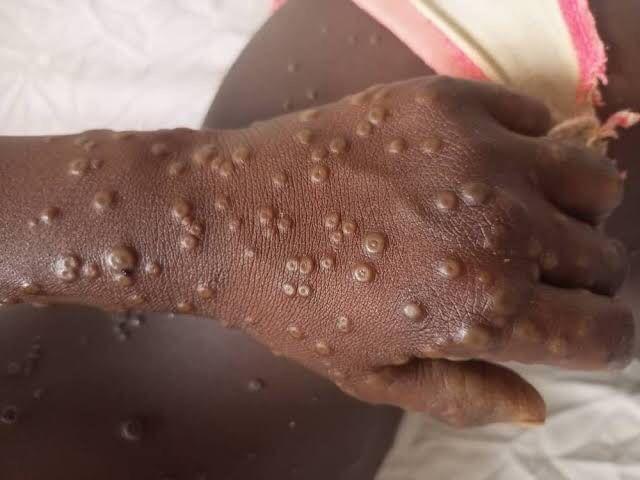 Mpox en RDC : la lutte s’intensifie, la vaccination débute le 2 octobre