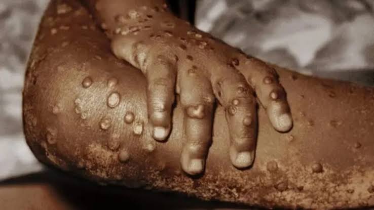 Mpox : 4 cas suspects notifiés dans la zone de santé de Mbanza-Ngungu au Kongo Central